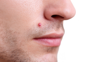 Herpes cold sore virus showing on man's face with transparent background png