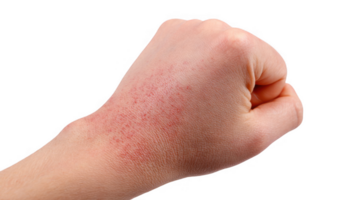 Hand showing allergy symptoms on transparent background png