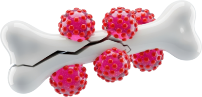 Fractured bone structure with invasive pink cells, medical illustration of disease png