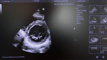Cardiac Ultrasound Examination Displayed on Screen, Real-Time Diagnostic Imaging with Parameters video