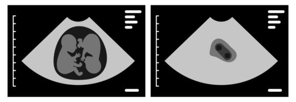 Ultrasound showing monozygotic twins interacting inside the womb, highlighting the deep connection and shared space of identical twins during prenatal development vector