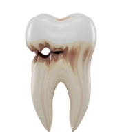 Decayed Molar with a Cavity Minimalist 3D Rendering in a Soft And Smooth Renderer png
