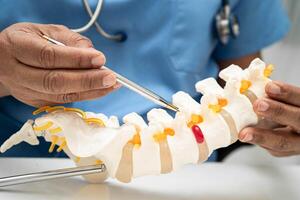 doctor spinal nerve and bone model, Lumbar spine displaced herniated disc fragment photo