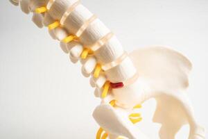 Lumbar spine displaced herniated disc fragment, spinal nerve and bone. Model for treatment medical orthopedic photo