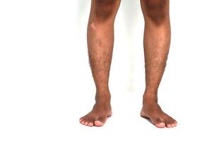 Close-up of a dark-skinned man's legs and feet, standing barefoot on a white surface, displaying vitiligo patch photo