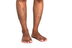 Isolated image of bare legs of dark skinned man, one leg with skin condition, standing on white surface photo