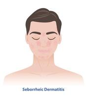Seborrheic Dermatitis on man face illustration. Sebderm, inflamed skin, scaly patches, flakes over the oilier areas of the face, over the eyebrows, sides of the nose, beard area, ears, eyelids. vector