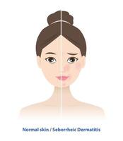 Comparison of normal skin and Seborrheic Dermatitis on woman face illustration. Sebderm, inflamed, red patches with white or yellow scale the face, sides of the nose, eyebrows, ears, eyelids. vector