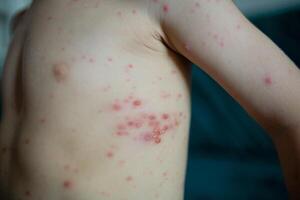 Child torso covered with chickenpox rash. Skin with red itchy blisters caused by varicella virus. Pediatric infectious photo