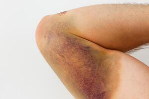 Bruised elbow showing signs of injury and healing over time photo