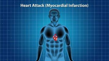 Animation illustrates myocardial infarction progression with detailed heart anatomy and artery blockage visualization video