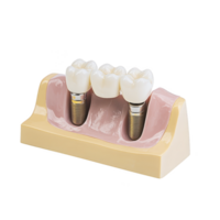 Dental implant model showing three artificial teeth on gum base, illustrating dental restoration and oral health. model is used for educational purposes in dentistry png