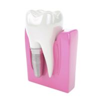 3D rendering of dental implant showcases realistic tooth model with metal implant embedded in pink gum tissue, illustrating modern dental procedures png