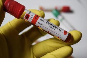 Hepatitis C vaccine - Test with blood sample in yellow gloved hands. healthcare or Medical concept photo