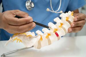doctor with spinal nerve and bone model, Lumbar spine displaced herniated disc fragment for treatment medical photo