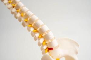 Spinal nerve bone, Lumbar spine displaced herniated disc fragment, Model for treatment medical in the orthopedic department. photo