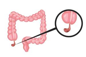 Magnifying glass showing appendicitis in human intestines vector
