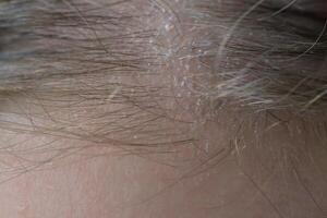 Close up of dry, irritated scalp with visible flakes. Concept of scalp health, dermatology, dandruff, haircare, discomfort and sensitive skin condition. photo