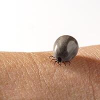 A close-up view shows a fully engorged tick attached to human skin, posing a public health risk. This parasite can transmit Lyme disease and other tick-borne illnesses. photo