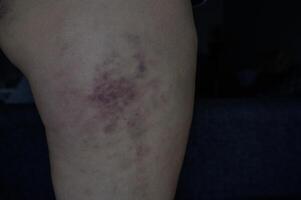 A person with a rash on their leg photo