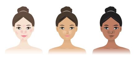 Seborrheic Dermatitis on different skin colors illustration. Sebderm, The rash may look redder in those with white skin and lighter or darker in people with brown or black skin. vector