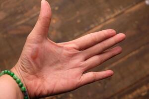 burns on the palms. blistered palms. photo