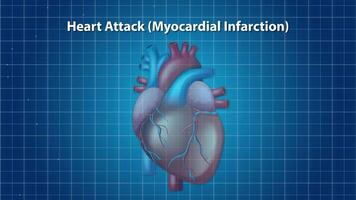 Illustrated animation of a heart attack, showing plaque buildup and artery blockage in a detailed, educational style video