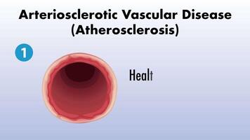 Illustration of atherosclerosis stages in an artery video