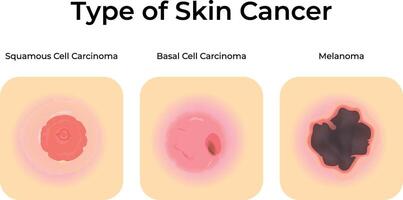 Types of Skin Cancer Squamous Basal Cell and Melanoma vector