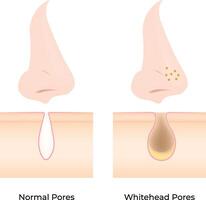 Normal Pores vs Whitehead Pores illustration vector