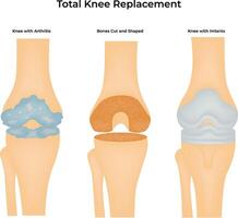Total Knee Replacement Surgical Process Visualization vector