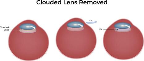 Clouded Lens Removed Science Design Illustration Diagram vector