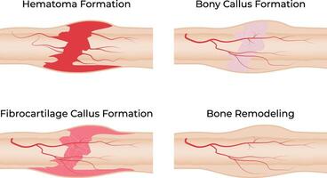 Stages of Bone Fracture Healing Hematoma Callus Formation and Remodeling vector
