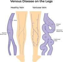 Venous Disease on the Legs Healthy vs Varicose Veins vector