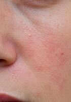 Close-up of facial redness skin and broken capillaries. Great for illustrating rosacea, sensitive skin, or irritation concerns photo