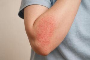 Detailed view of a human arm with a pinkish red scaly skin rash on the inner elbow photo