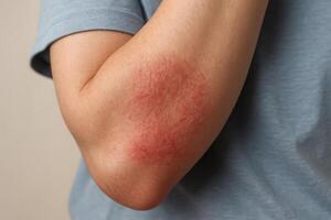 Close up of a human arm with a red, scaly skin rash on the inner elbow, showing dermatitis photo
