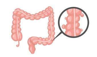 Diverticulosis affecting large intestine highlighted by magnifying glass vector