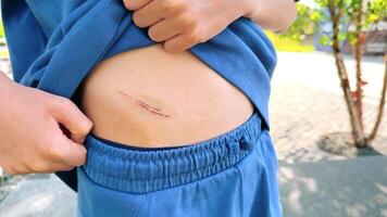 Child shows injury with bruising on the side after playing outdoors at the park, a common playground accident video