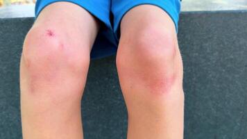 Child with scrapes on knees playing outside after falling down during playtime video