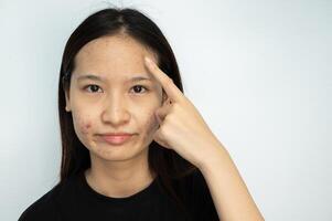 Portrait of young Asian woman pointing to acne problems on her face. photo