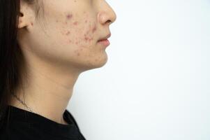Side view of Asian woman having acne inflamed on her face. photo