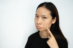 Serious Asian woman pointing to acne problems on her face. photo