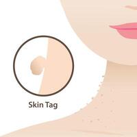 Infographic of skin tags are side of the neck woman, small excess pieces of skin that protrude from surface, structured with blood vessels, collagen and fat cells. Skin tag icon illustration. vector