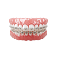Human Teeth with Orthodontic Braces. Transparent Background for Dental Health, Smile Alignment, Orthodontist Services, and Medical Illustration Use png