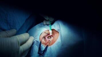Laser vision correction video