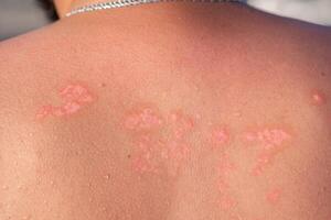 Psoriasis Patches on Skin During Sunny Day Outdoors, Highlighting Skin Condition on Back of Individual at Public Location photo