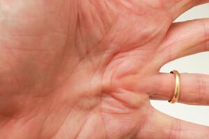 Man with Dupuytren Contracture on the palm of his hand photo