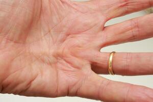 Older Man with Dupuytren Contracture on the palm of his hand photo