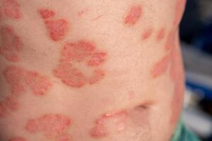 Understanding Psoriasis Through Close-Up View of Skin Lesions on a Persons Back in Clinical Setting photo